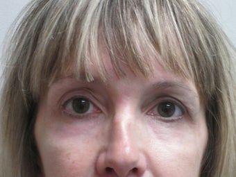 Peri Orbital Laser Resurfacing