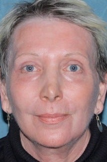 Laser resurfacing treatment for wrinkles