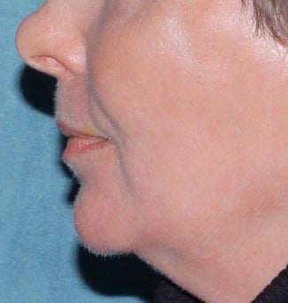 Laser resurfacing for mouth