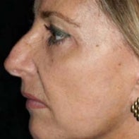 Laser Resurfacing