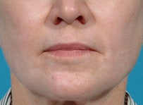Laser resurfacing-Erbium ablative resurfacing