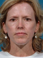 Laser resurfacing-Erbium ablative resurfacing