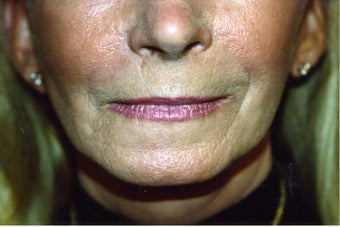 Laser Skin Resurfacing with Dr. Clevens
