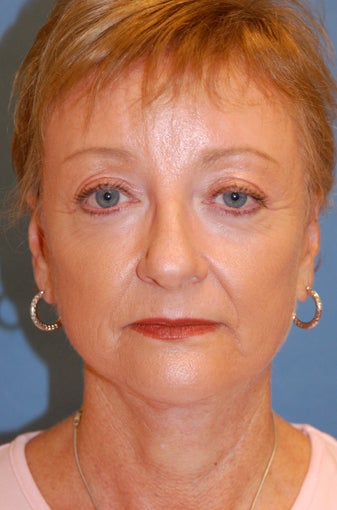 Laser Skin Resurfacing with Dr. Clevens