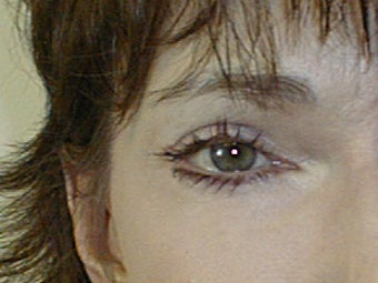 Mixto Fractionated Laser Resurfacing Treatment
