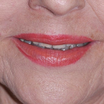 Laser Resurfacing