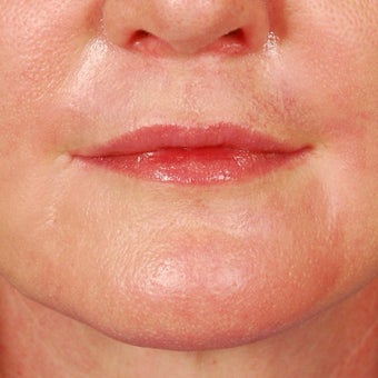CO2 Laser Resurfacing