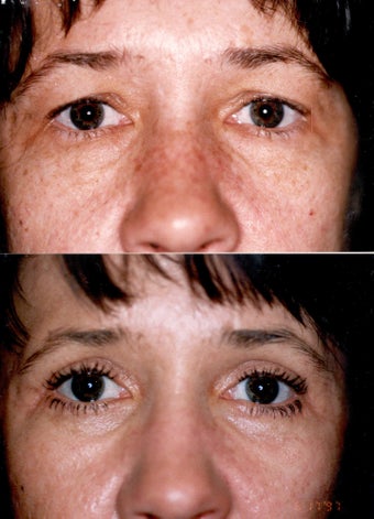 Blepharoplasty and Full Face CO2 Laser Resurfacing