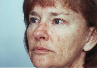 Laser Resurfacing