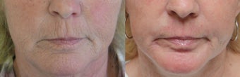 Full Face Laser