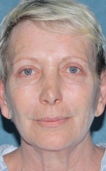 Laser resurfacing treatment for wrinkles
