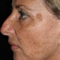Laser Resurfacing