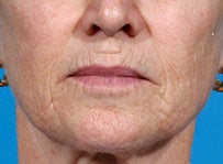 Laser resurfacing-Erbium ablative resurfacing