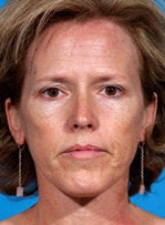 Laser resurfacing-Erbium ablative resurfacing