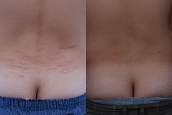 Stretch Mark Removal 