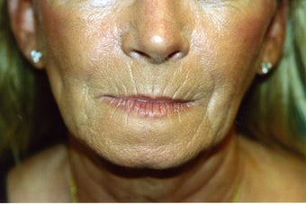 Laser Skin Resurfacing with Dr. Clevens