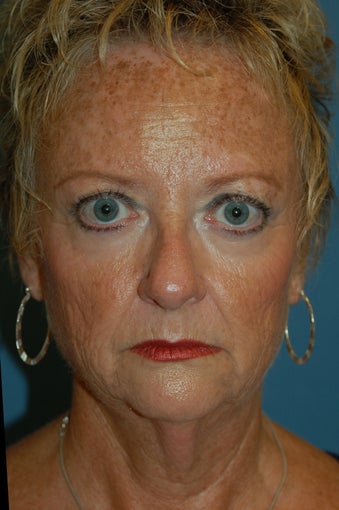 Laser Skin Resurfacing with Dr. Clevens