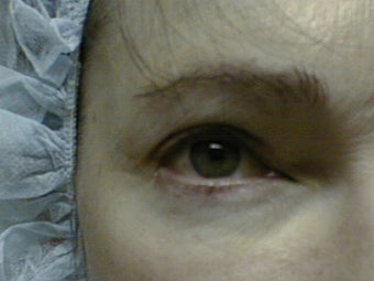 Mixto Fractionated Laser Resurfacing Treatment