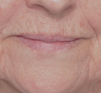 Laser Resurfacing