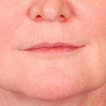 CO2 Laser Resurfacing
