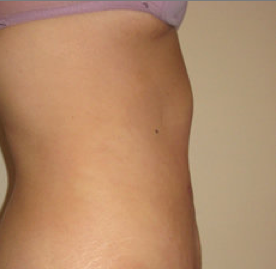 Laser Surgery