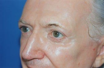 Laser Skin Resurfacing with Dr. Clevens