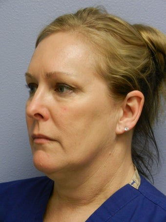Laser Liposuction 