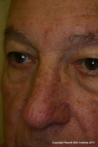 Varilite laser treatment of facial veins