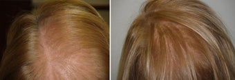 Low Lever Laser Light Therapy