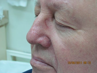 Laser vein treatment of veins on the nose