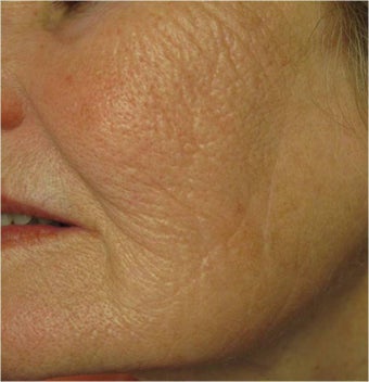 Evolastin- Non Surgical Lift