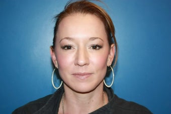 BBL and MLP Laser treatment for hyperpigmentation