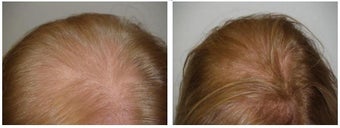 Low Lever Laser Light Therapy