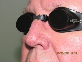 Laser vein treatment of veins on the nose
