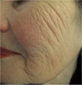 Evolastin- Non Surgical Lift