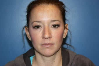 BBL and MLP Laser treatment for hyperpigmentation