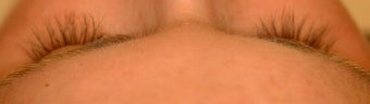 Latisse for eyelashes