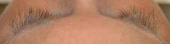 Latisse treatments for eyelashes