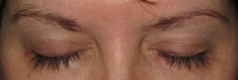 Latisse before and after