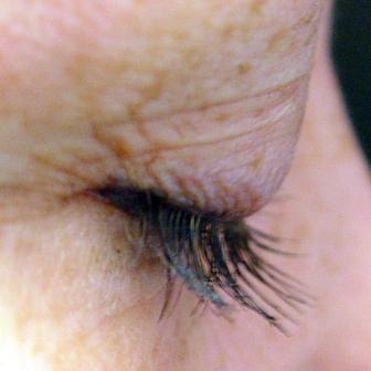 Dr. Lorrie Klein's eyelashes before and after Latisse