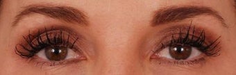 Eyelash Growth from Latisse