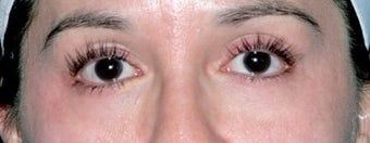 Latisse for Eyelashes