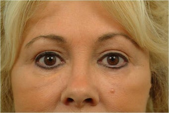 Upper and Lower Blepharoplasty