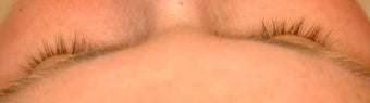 Latisse for eyelashes