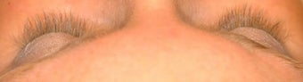 Latisse treatments for eyelashes