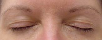 Latisse before and after