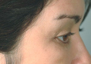 Latisse for eyelashes