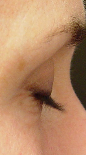 Lashes treated with Lumigan/Latisse