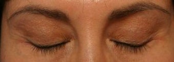 LATISSE