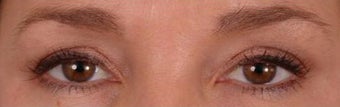 Eyelash Growth from Latisse